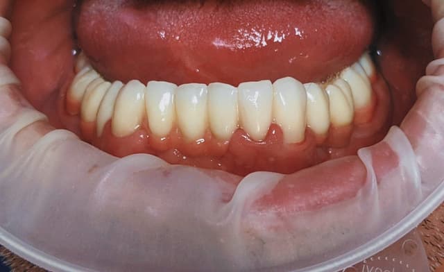 Zirconiu - Exemplu 1