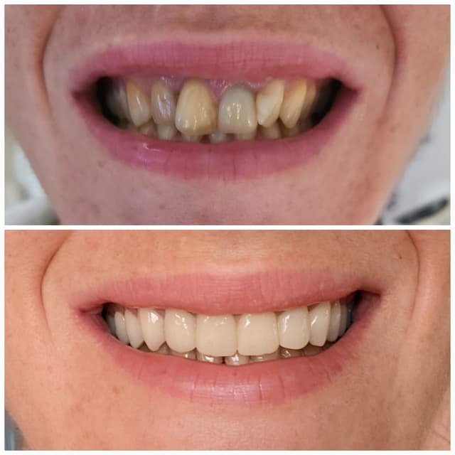 Zirconiu - Exemplu 4