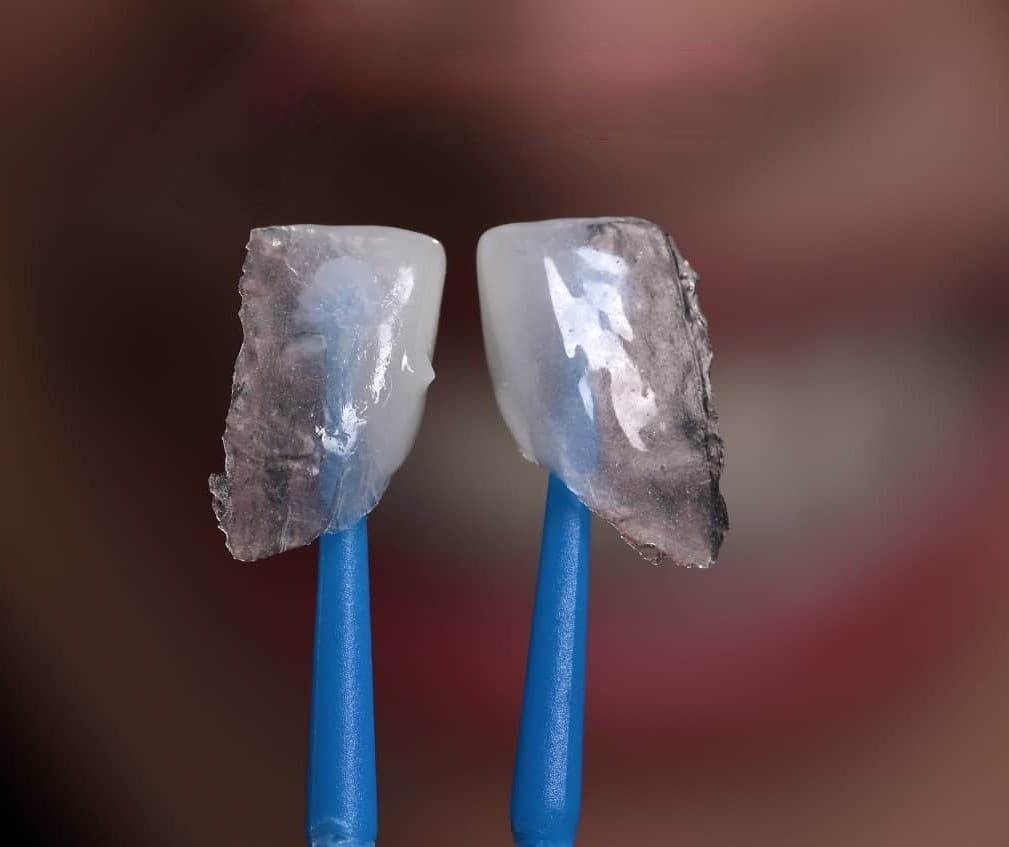 Fațete dentare ceramice