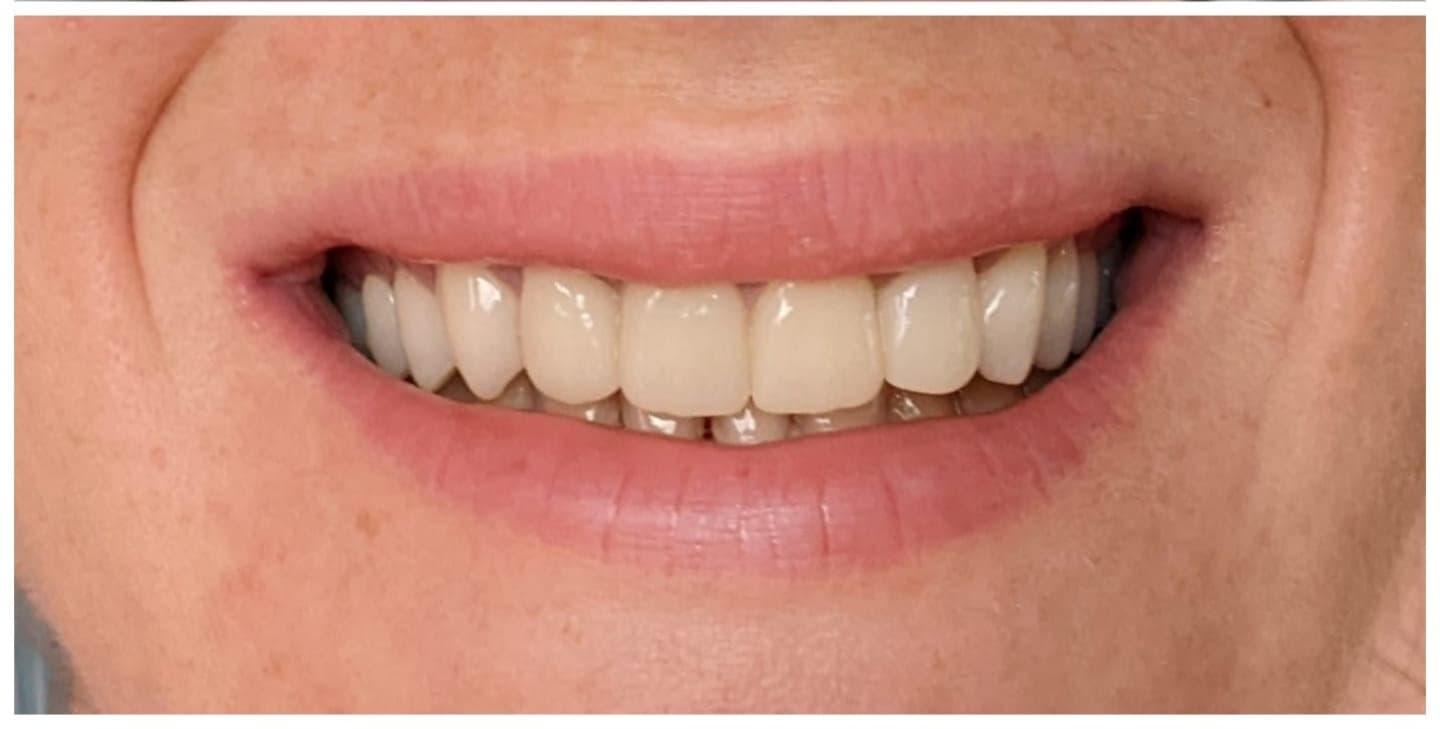 Lucrări protetice de calitate