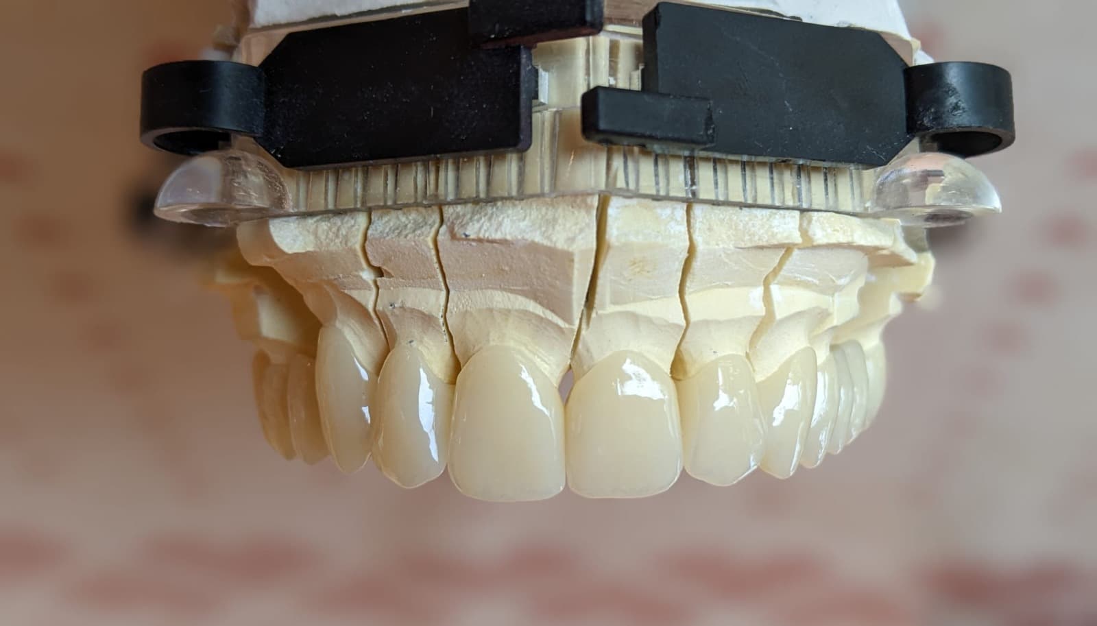 Coroane dentare din zirconiu