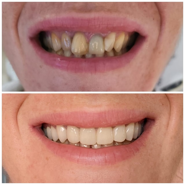 Zirconiu - Exemplu 4